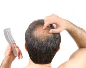 Treating Alopecia Areata in Maryland