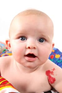 Birthmark treatment in Maryland