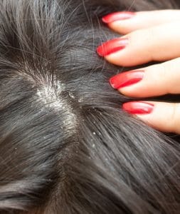 Treating dandruff in Maryland