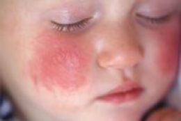 Atopic Eczema and Dermatitis Treatment in Maryland