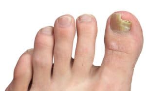 Toenail Fungus Treatment in Maryland