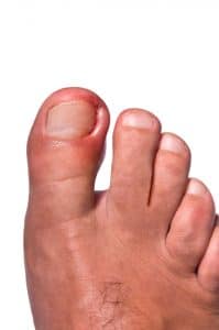 Treat ingrown toenails