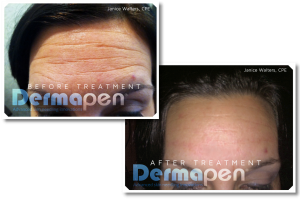 Micro Needling Wrinkle Treatments