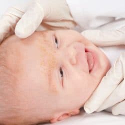 Cradle Cap Treatment