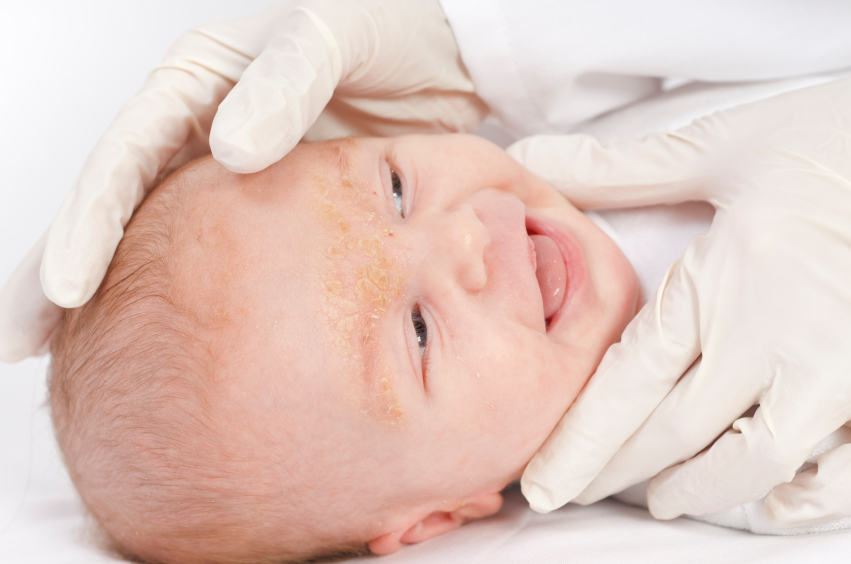 Cradle Cap