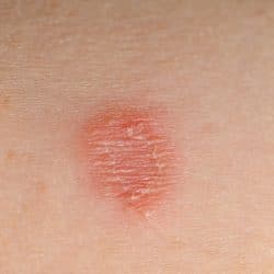 Common toddler skin conditions - Ringworm Infection