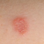 Tinea corporis infection (ring worm)