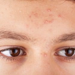 Acne in Adolescents