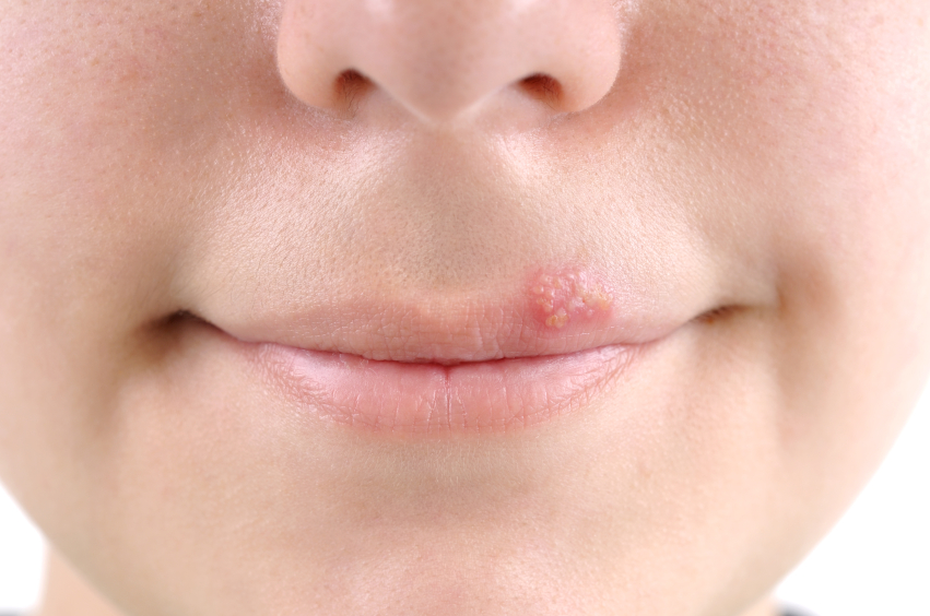 cold sore in adolescents