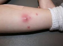 Child with MRSA infection