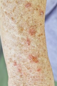 Actinic Keratosis