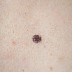 melanoma