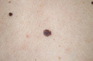 melanoma