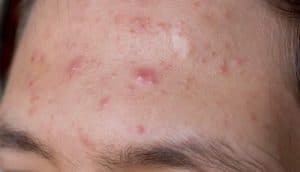 acne on forehead