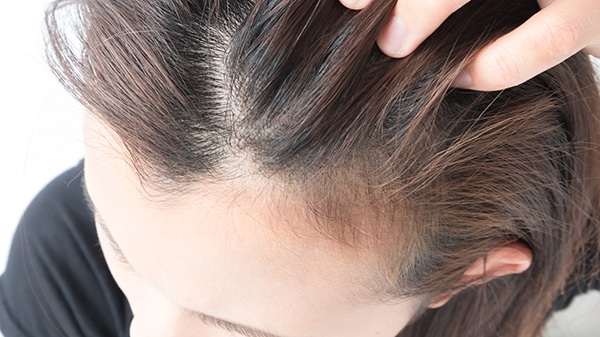 Telogen Effluvium hair loss