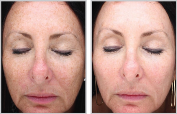 Halo Fractional Laser Photos