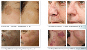 BroadBand Light Treatment - before and after photos of BBL