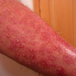 psoriasis treatment psoriasis treatments 0