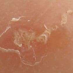 what is scabies scabies symptoms scabies treatments