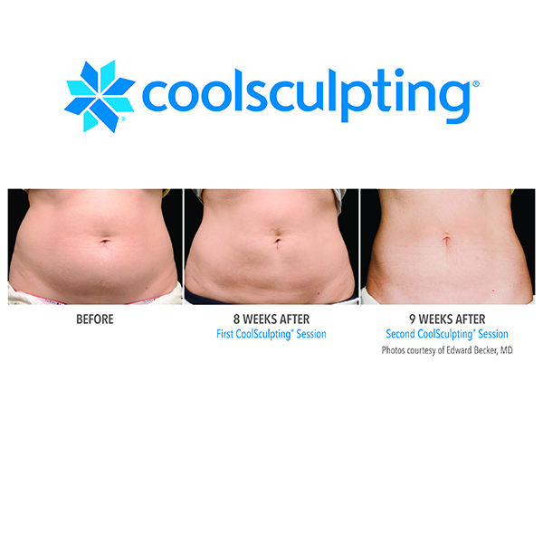 CoolSculpting