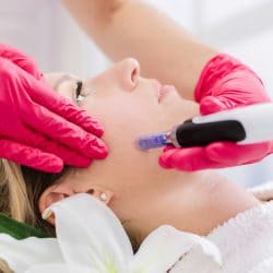 Microneedling: What You Need to Know